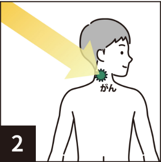 2.光レーザー照射