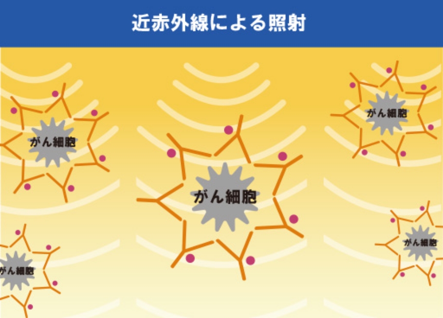 がん細胞だけを選んで攻撃する低侵襲治療